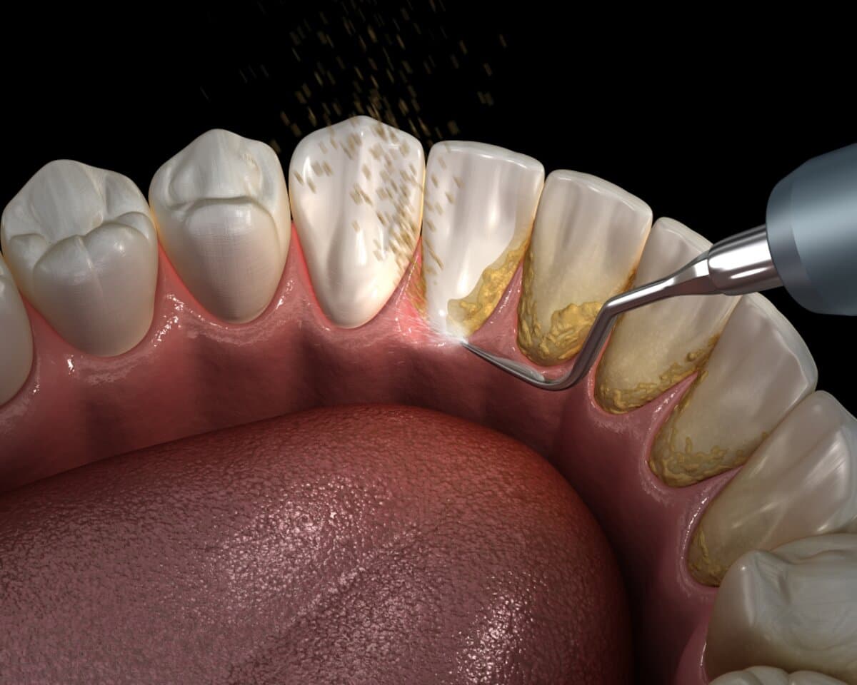Dental Exams & Teeth Cleanings