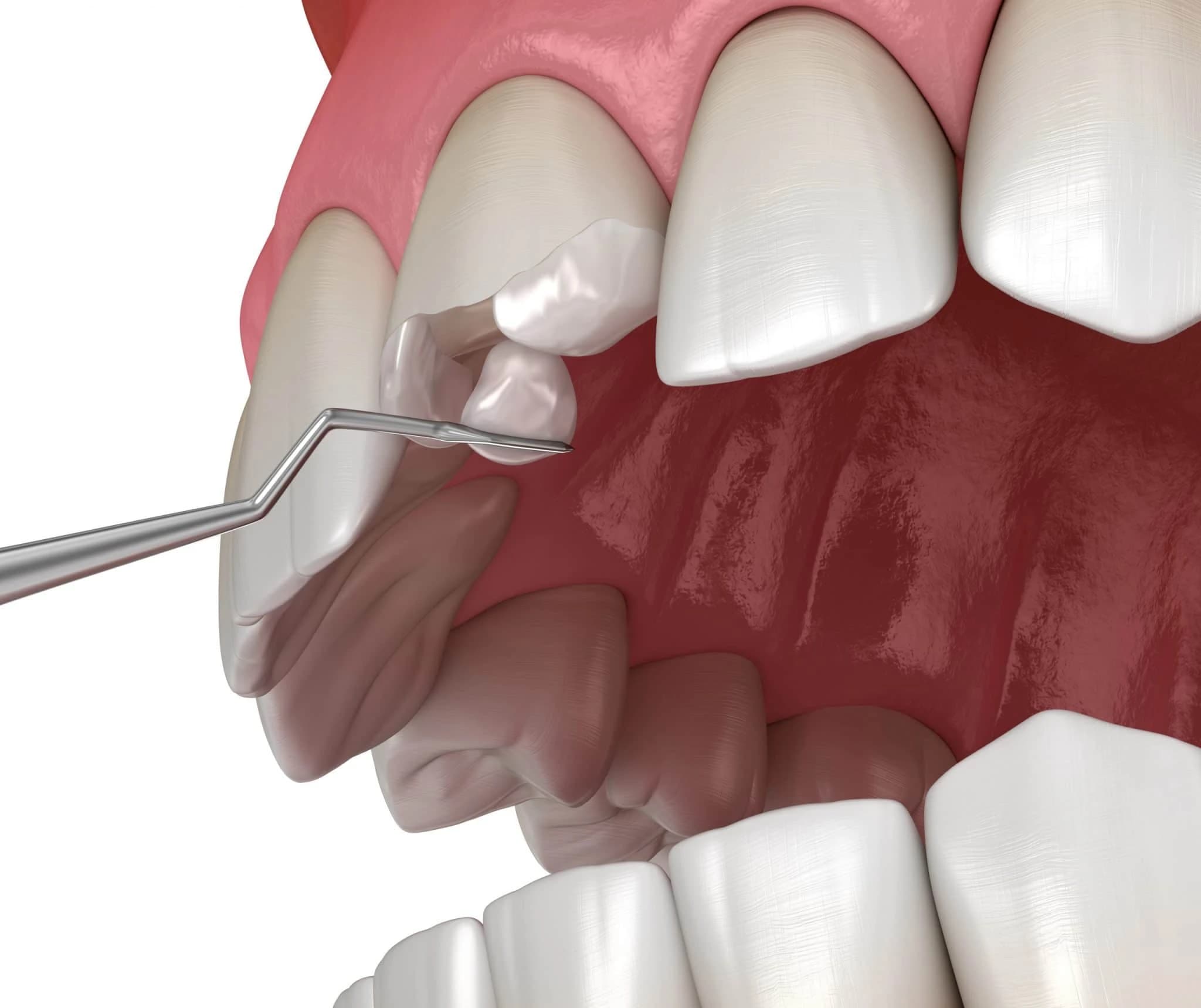 Restorative Dentistry at Tribeca Dental Studio