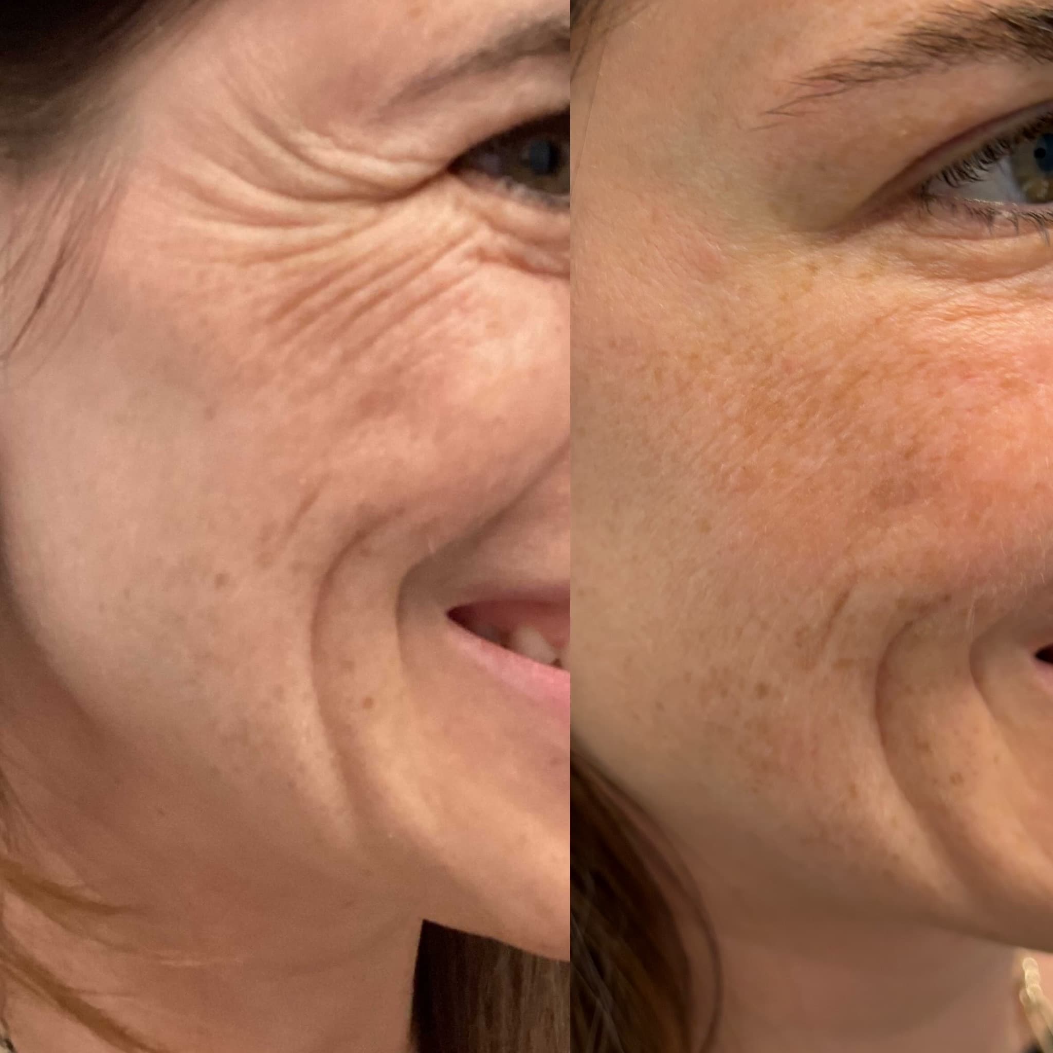 Before and after crow's feet Botox treatment by Dr. Marina Krasnopolsky