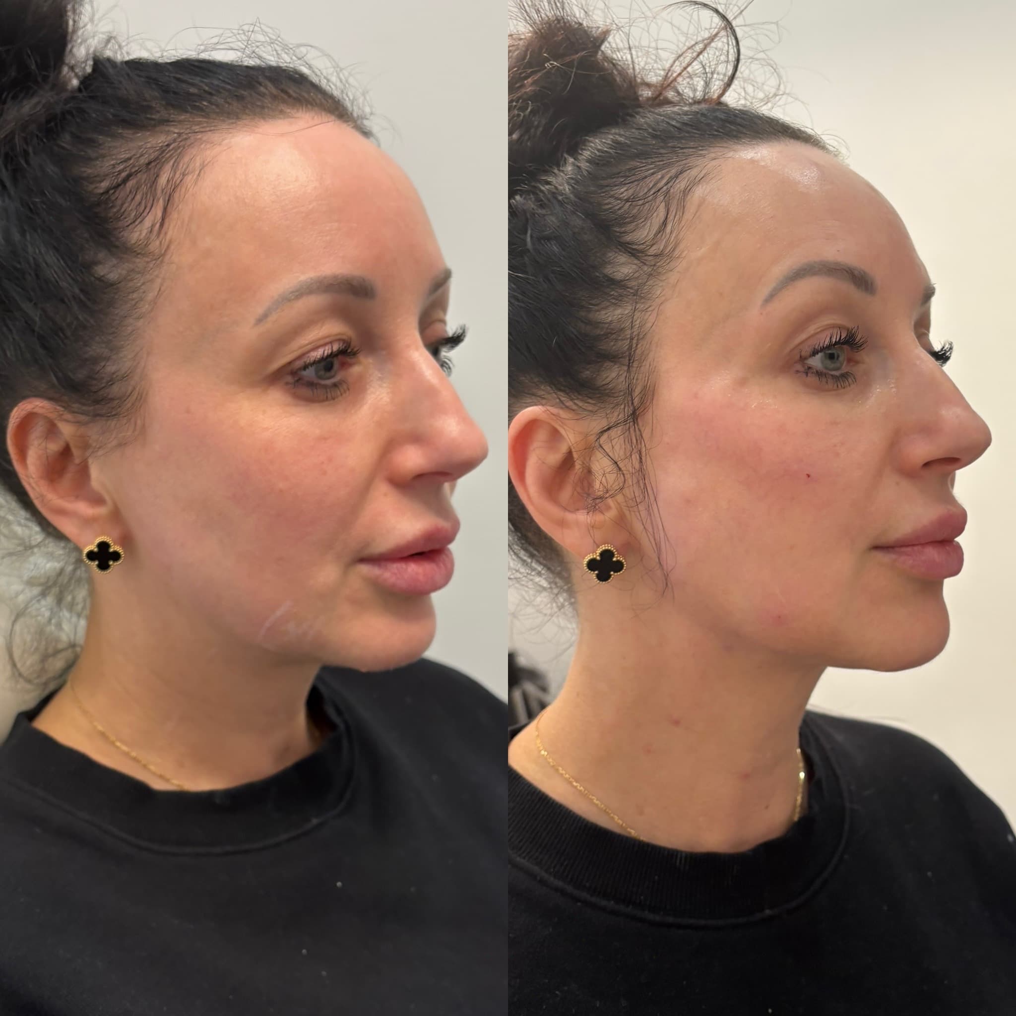 Before and after full facial balancing with Radiesse and hyaluronic acid fillers by Dr. Marina Krasnopolsky