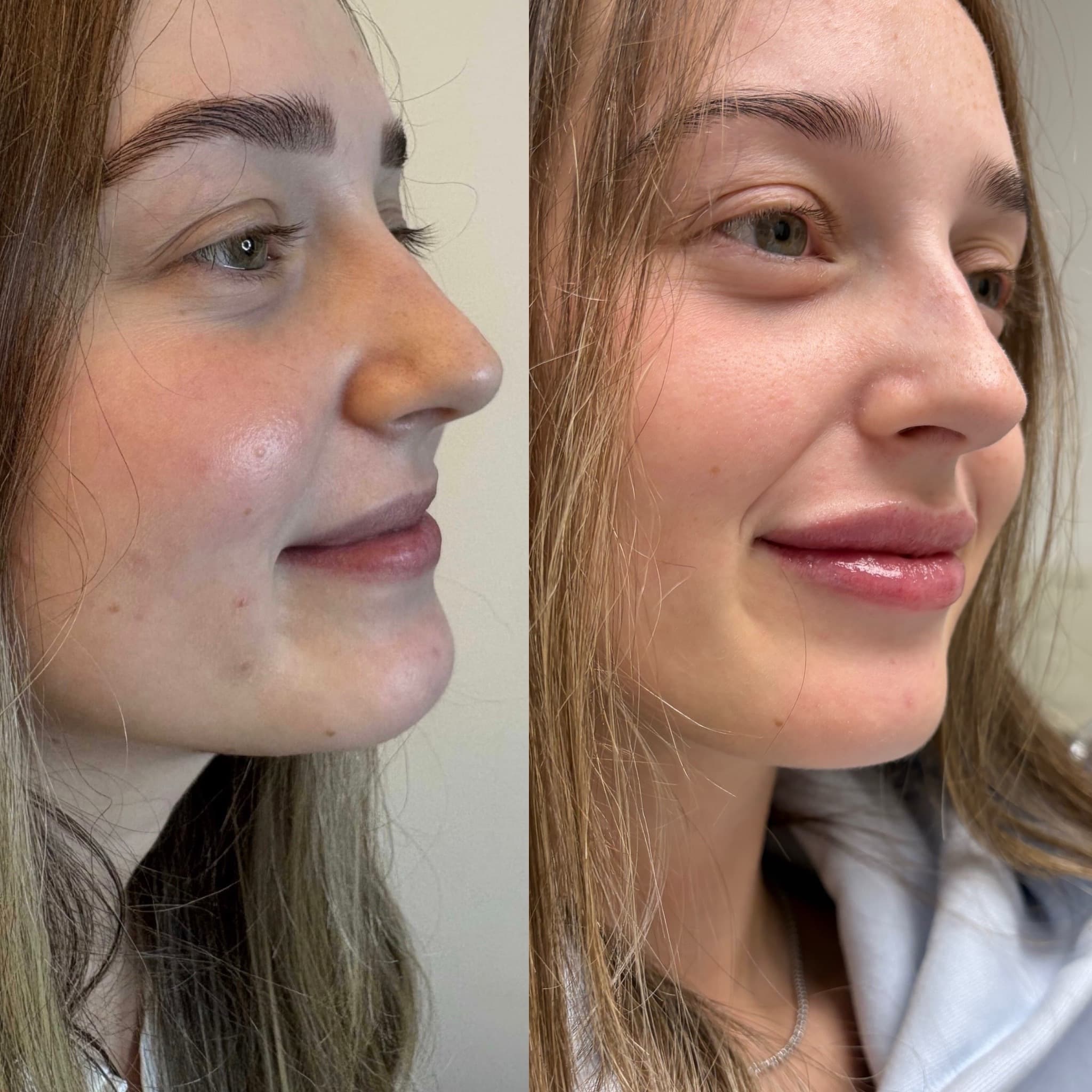 Before and after lip filler treatment by Dr. Marina Krasnopolsky
