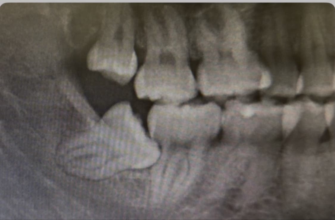 X-ray: wisdom tooth damaging the molar in front of it