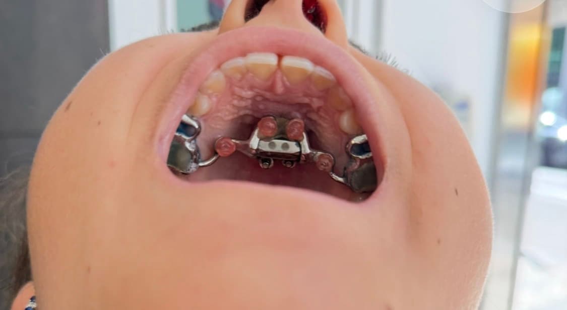 MARPE palatal expander appliance installed on a patient's upper jaw