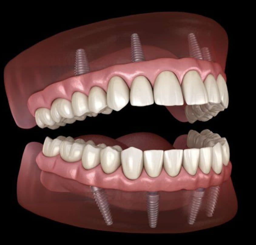 Full and partial dentures at Tribeca Dental Studio in Tribeca, NYC - denture options from conventional to implant-supported