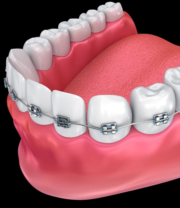 Traditional braces orthodontics at Tribeca Dental Studio