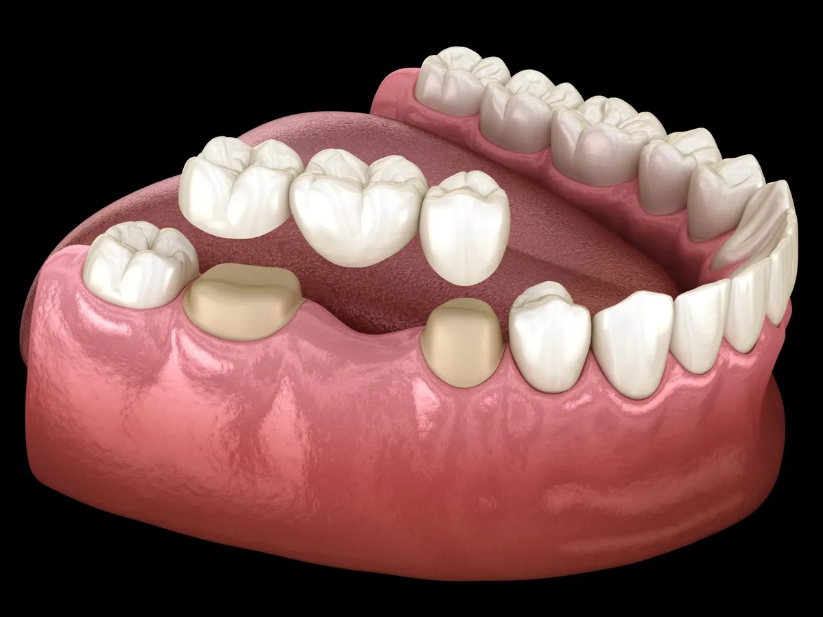 Custom dental bridge restoring a patient's smile at Tribeca Dental Studio in Tribeca, NYC