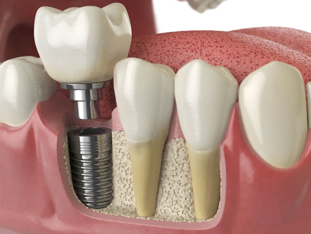 Implantes Dentales