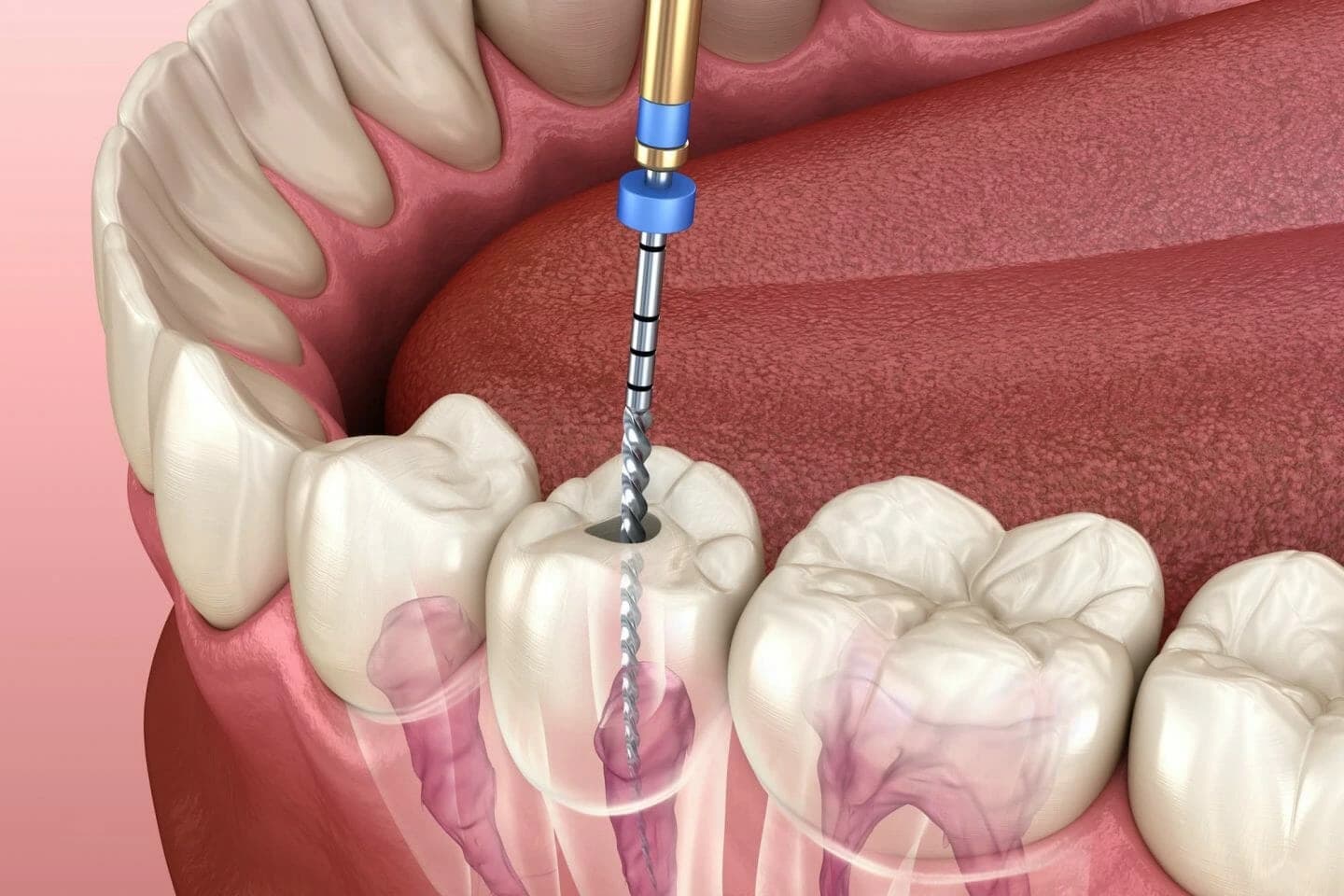 Microscope Root Canal Treatment at Tribeca Dental Studio