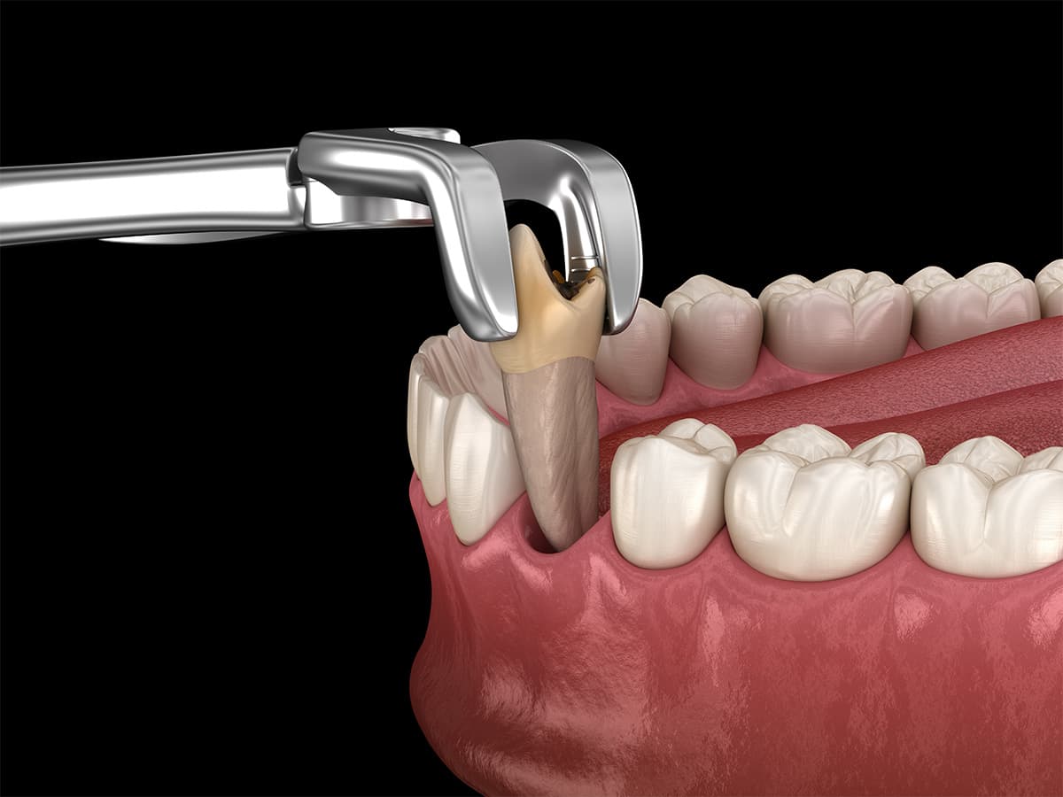 Tooth extraction near me in NYC — careful tooth removal and replacement planning at Tribeca Dental Studio