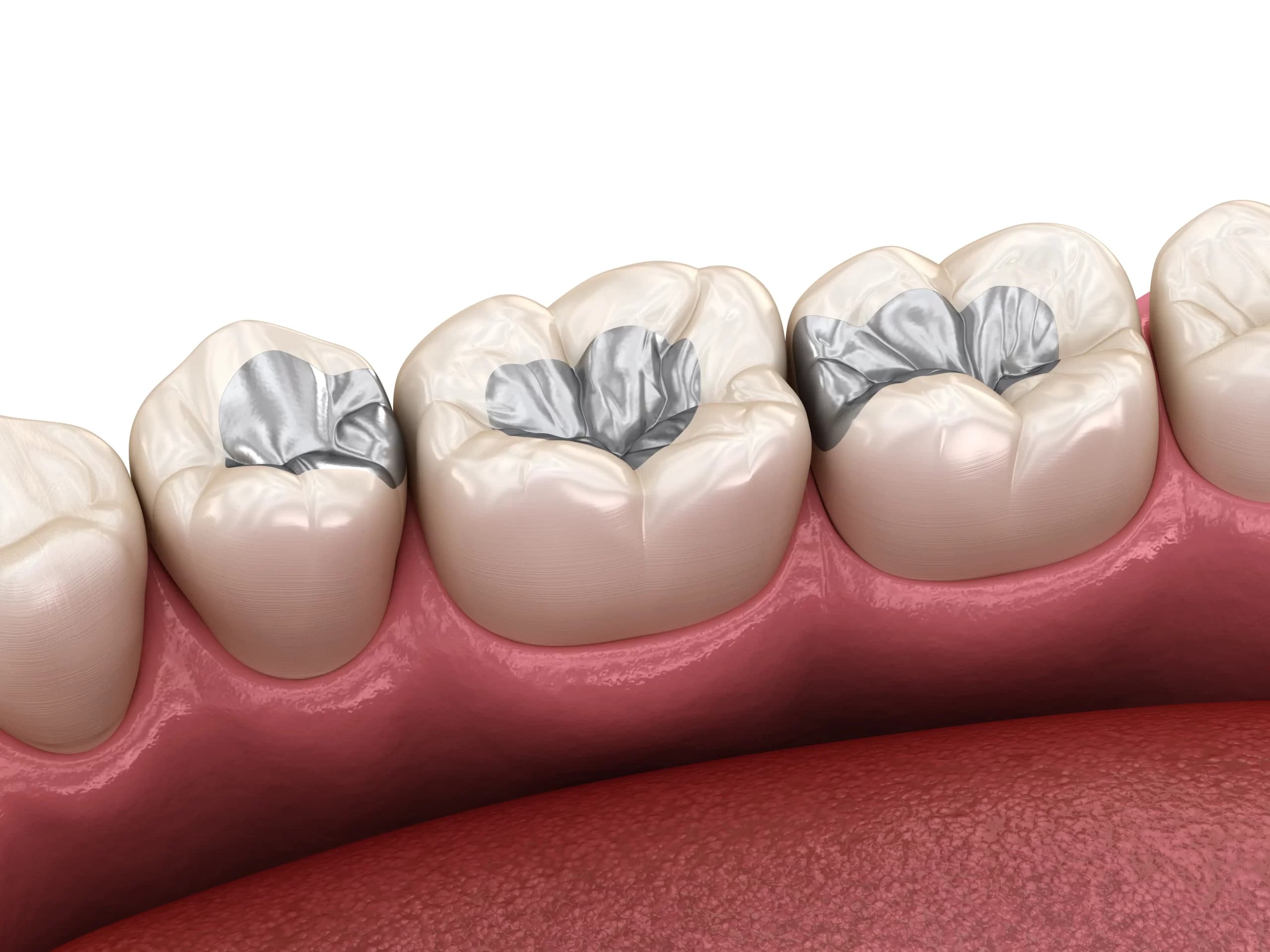 In-house endodontics in NYC — root canal care at Tribeca Dental Studio, Manhattan