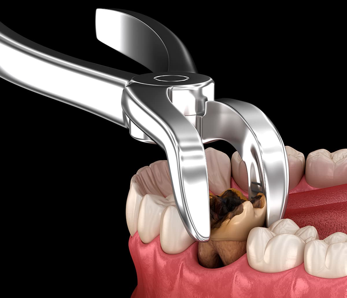 Tooth Extractions