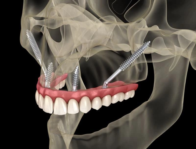 Zygomatic Implants at Tribeca Dental Studio NYC