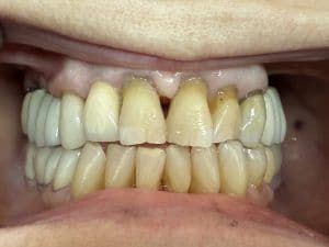 What to Do When You Chip Your Tooth Enamel