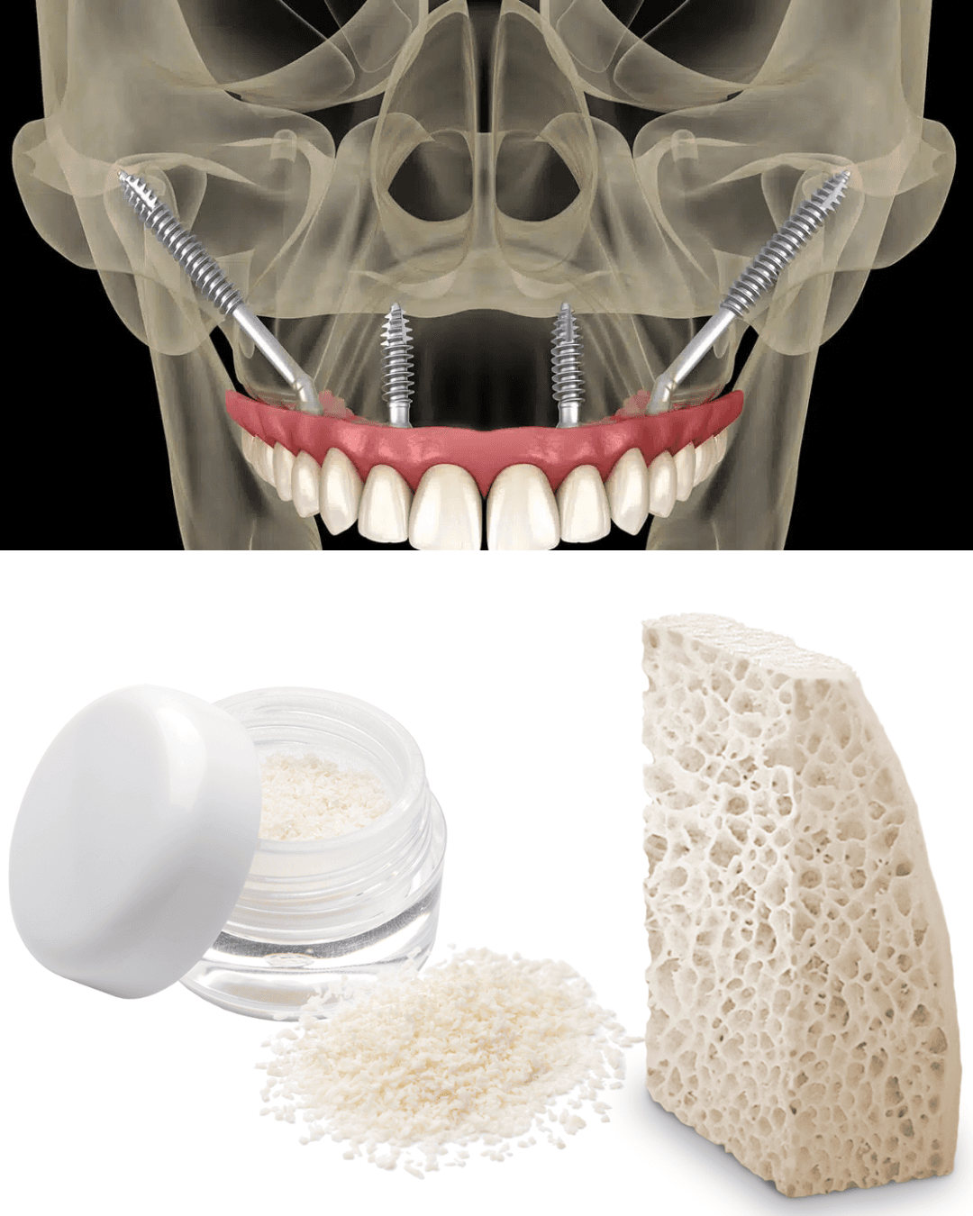 Dental Implants for Severe Bone Loss in Tribeca: Zygomatic & Bone Grafting Solutions