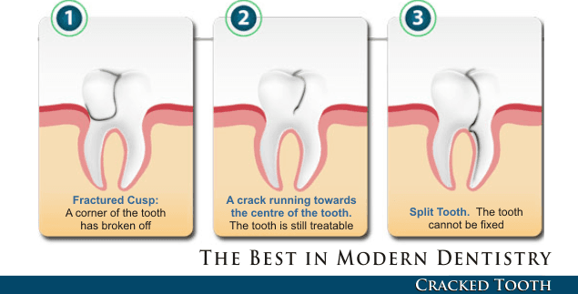 From Cracked to Crowned: How to Fix a Broken Dental Crown