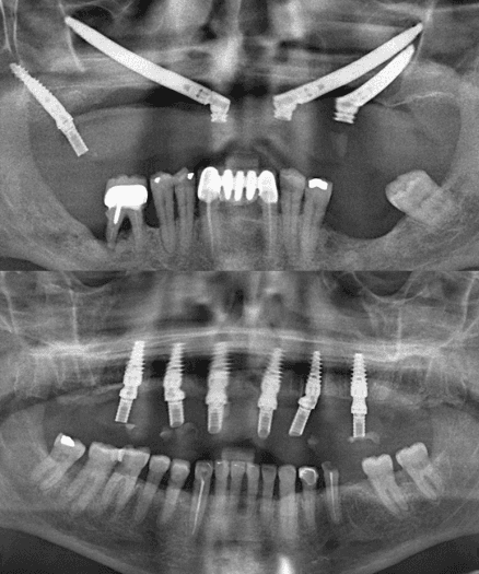 Best Dental Implants NYC 2025: Zygomatic vs All-on-6 Guide