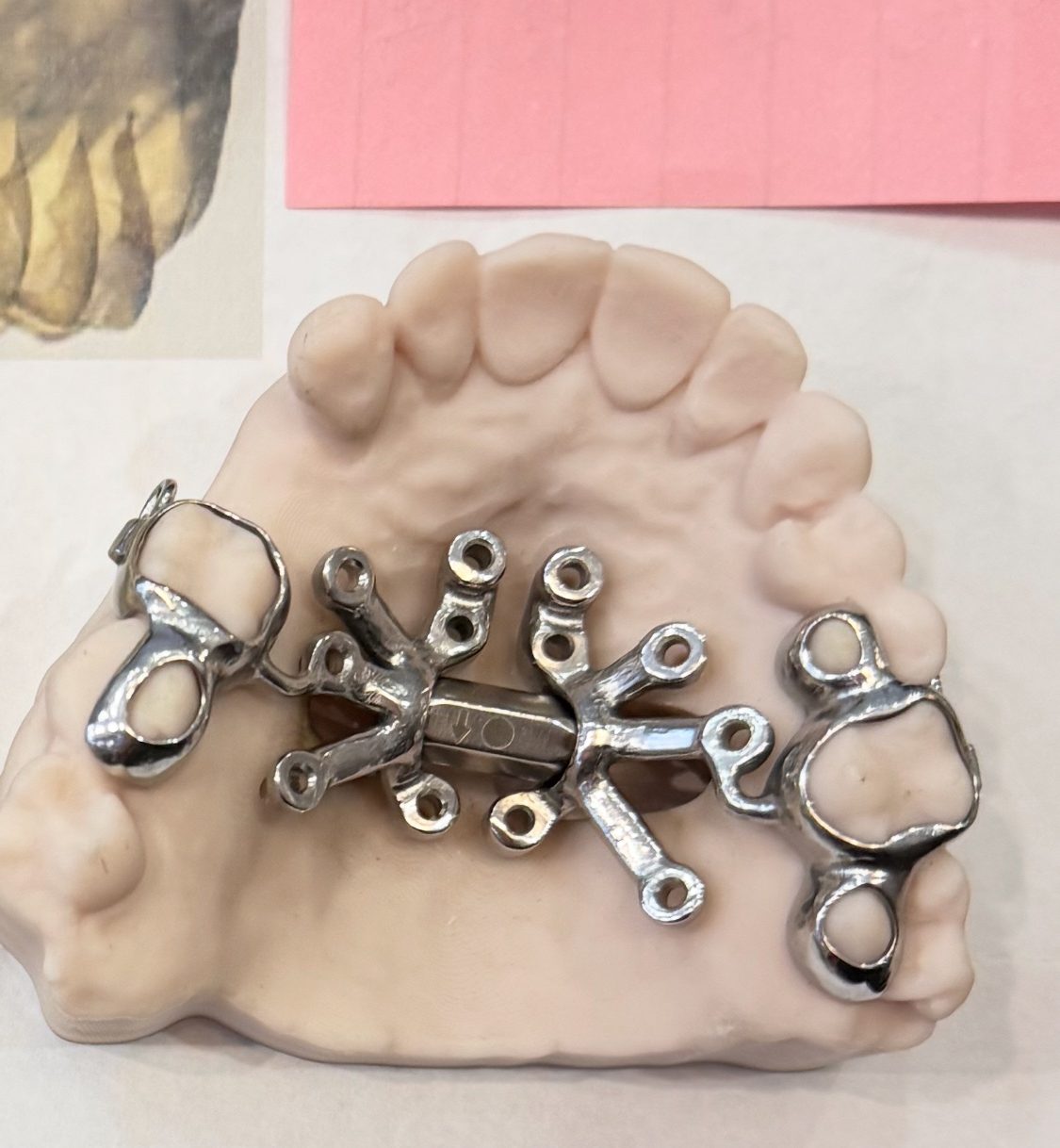 MARPE appliance on a dental model showing the miniscrew ports