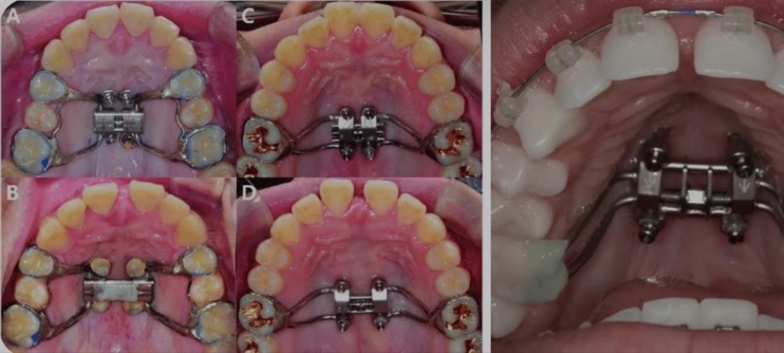 MARPE expander examples fitted in patients