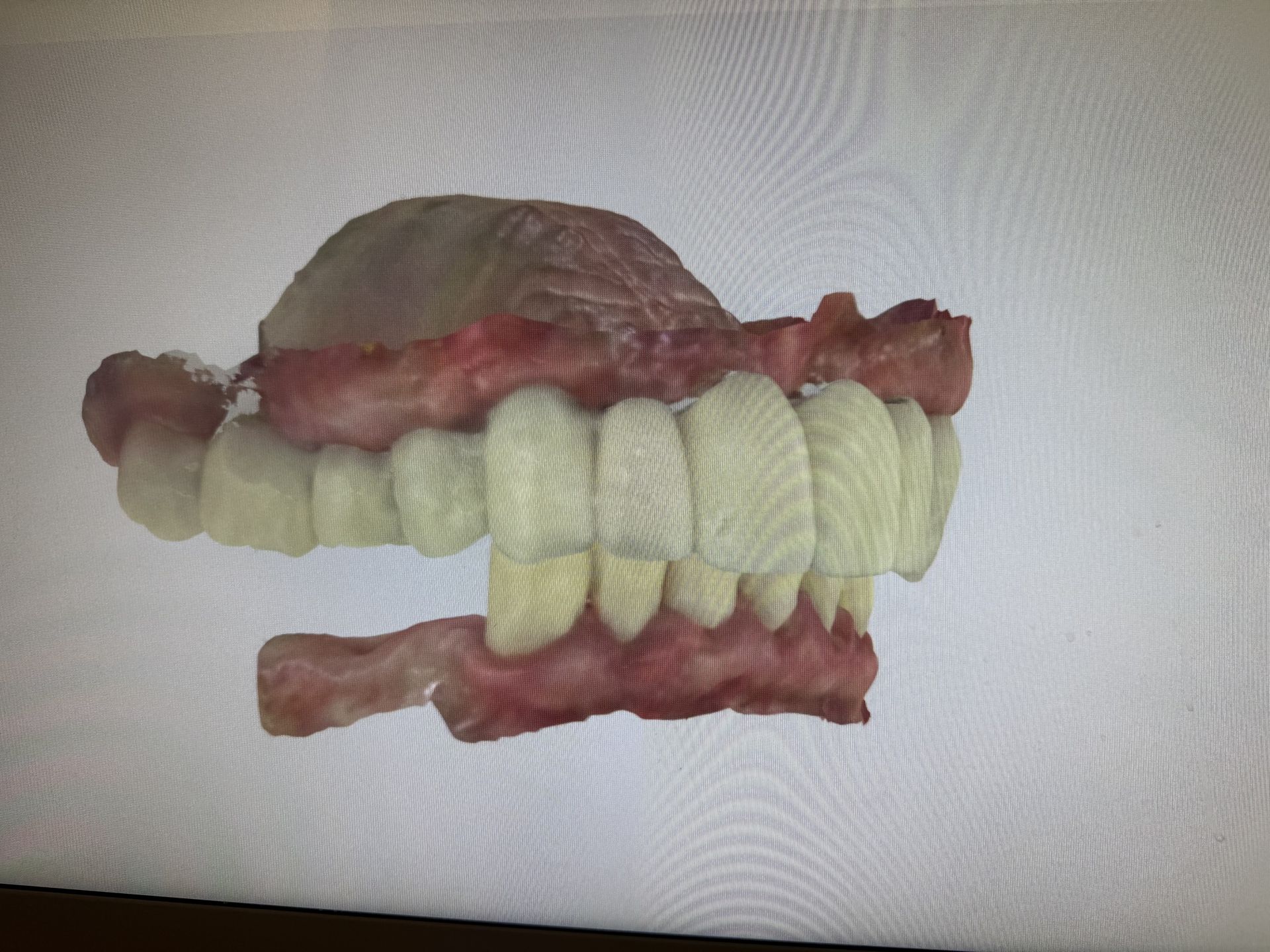 Example of severe upper jaw bone loss evaluated for advanced dental implant treatment